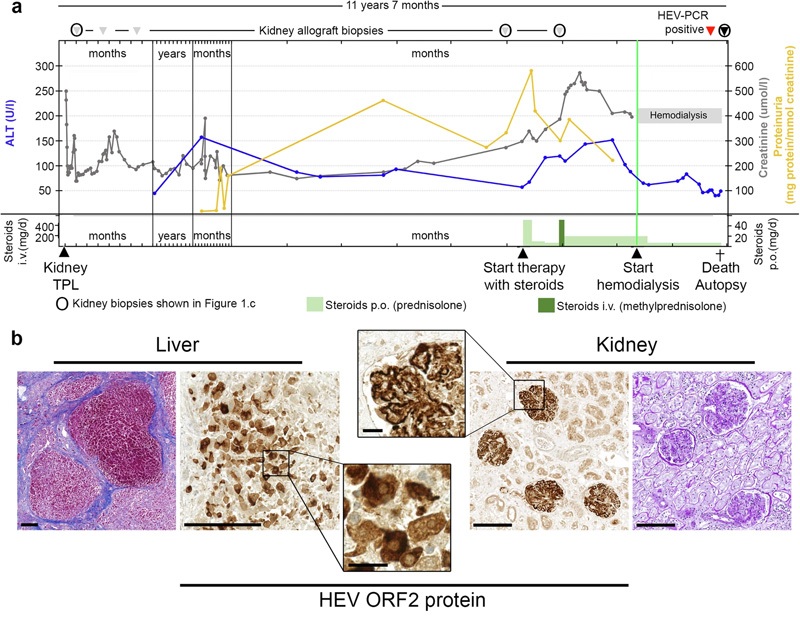 
戊型肝炎腎移植受者膜增殖型免疫復(fù)合物腎小球腎炎的臨床過程、尸檢結(jié)果和逐漸發(fā)展