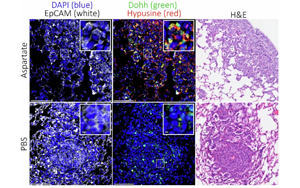 Nature：癌癥轉移時為何青睞肺部？