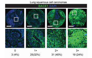 CRISPR激活篩選揭示BACE1驅(qū)動非小細(xì)胞肺癌腦轉(zhuǎn)移的機(jī)制及治療潛力