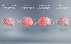 基因-代謝組-飲食互作在癡呆風(fēng)險中的精準(zhǔn)預(yù)防：APOE4純合子特異性代謝通路與地中海飲食的調(diào)控作用