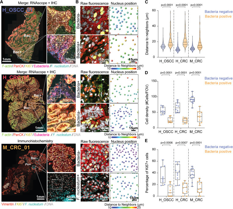 細(xì)菌感染微灶內(nèi)癌細(xì)胞的空間分布