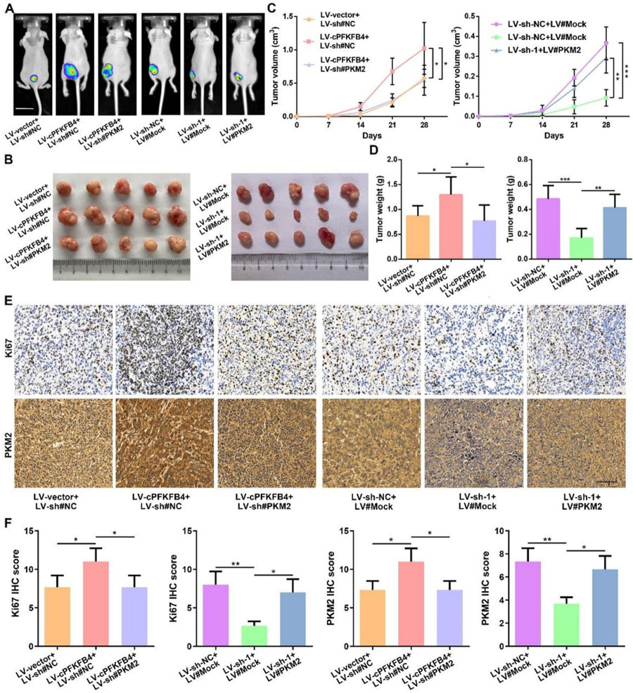 cPFKFB4通過PKM2促進胰腺癌惡性進展