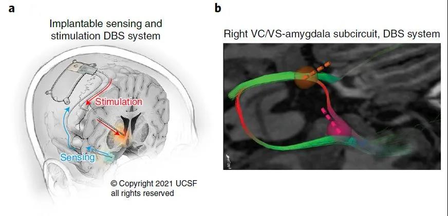 腦電刺激成功拯救重度抑郁癥患者，治愈抑郁癥時代離我們不遠了？