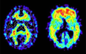 新冠帶來新的“醫(yī)療壓力”：阿爾茨海默病的風(fēng)險(xiǎn)飆升50%-80%