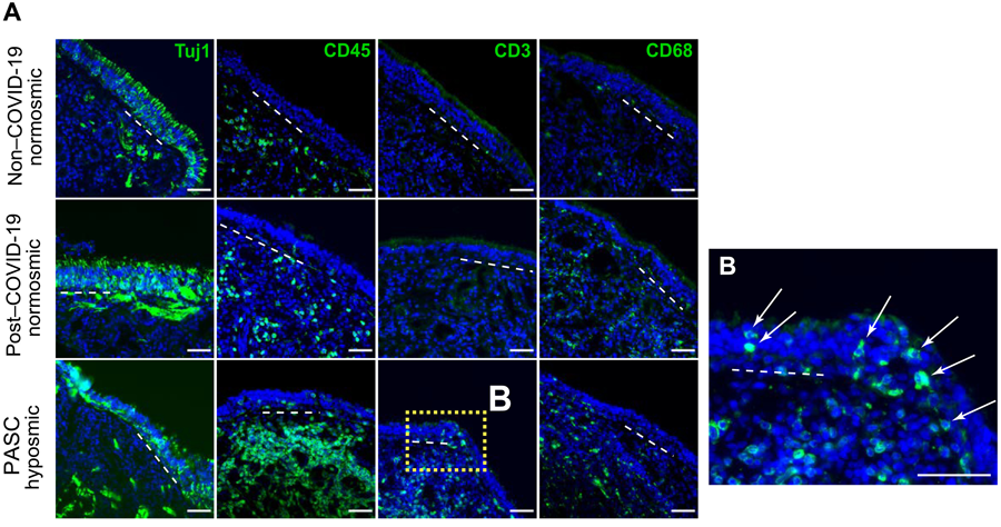 新冠肺炎急性后遺癥嗅覺粘膜下丘組織學(xué)評估提示T細(xì)胞浸潤的作用