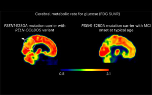 Nature Medicine發(fā)現(xiàn)了新的基因變異，可以預(yù)防阿爾茨海默病